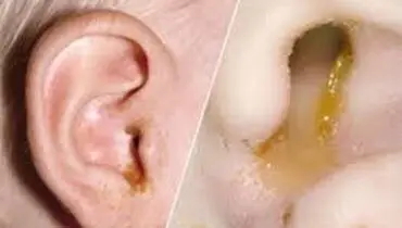 
هر آنچه که باید درباره مایع پشت پرده گوش بدانید!
