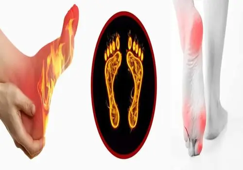 داغی کف پا در شب از ابتلا به این بیماری خبر میدهند