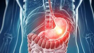 اثر ریفلاکس معده بر بروز اختلالات خواب
