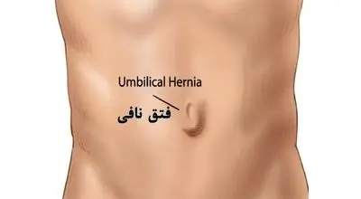 نکات مهم مراقبت بعد از جراحی فتق ناف
