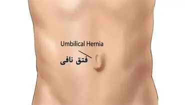نکات مهم مراقبت بعد از جراحی فتق ناف

