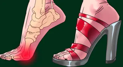 آیا کفش پاشنه‌بلند شکل پا را تغییر می‌دهد؟