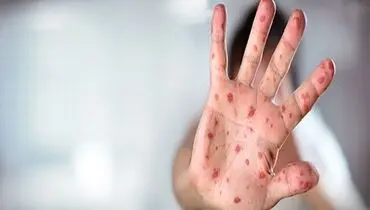 ایران در مرحله حذف سرخک و سرخجه