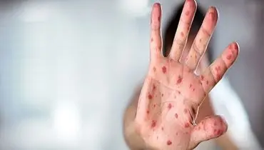 ایران در مرحله حذف سرخک و سرخجه