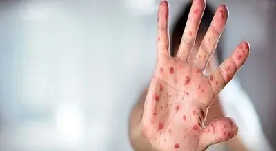 ایران در مرحله حذف سرخک و سرخجه