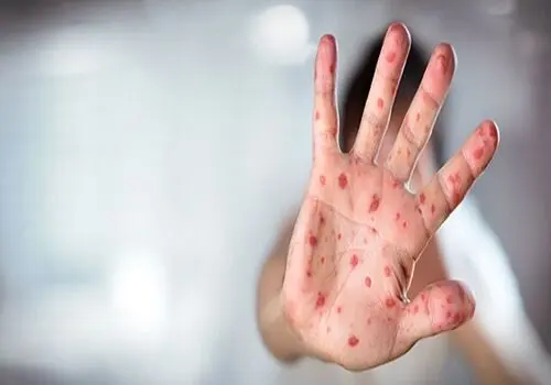 گزارش جدید سازمان جهانی بهداشت از شیوع سرخک