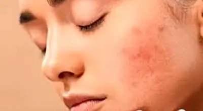  مضرات الکل برای پوست