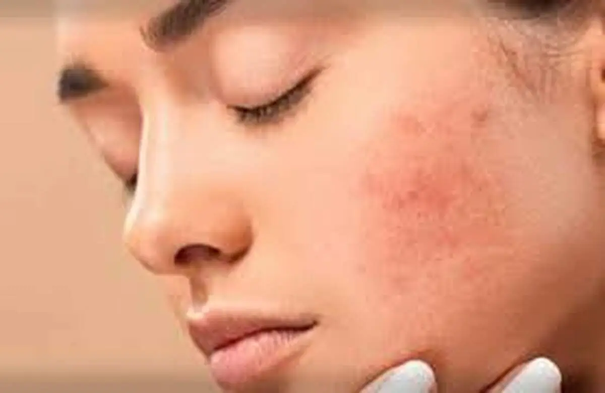  مضرات الکل برای پوست