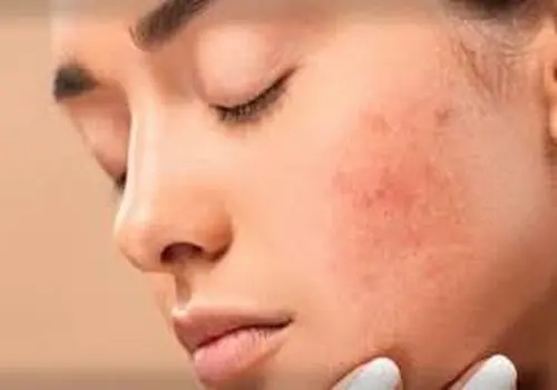 هیالورونیک اسید چگونه بر زیبایی پوست اثر می‌گذارد؟

