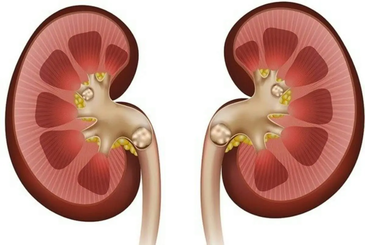 راه نجات کلیه ها از گرما