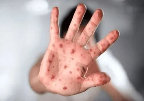 آبله میمونی همچنان در وضعیت اضطرار

