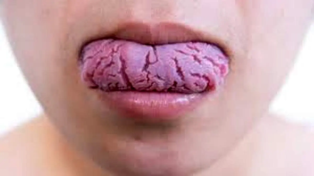 ترک خوردن زبان چه علتی دارد ؟
