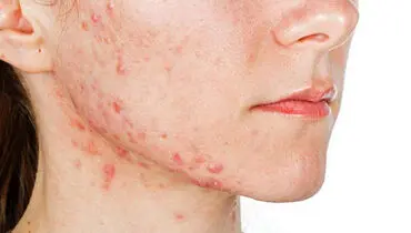 چه خوراک‌هایی باعث تشدید آکنه صورت می‌‌شوند؟
