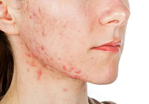 چه خوراک‌هایی باعث تشدید آکنه صورت می‌‌شوند؟
