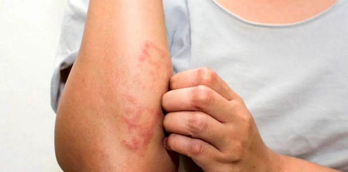 حساسیت غذایی چیست و چه نشانه‌هایی دارد؟
