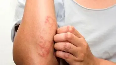 حساسیت غذایی چیست و چه نشانه‌هایی دارد؟
