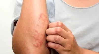 حساسیت غذایی چیست و چه نشانه‌هایی دارد؟
