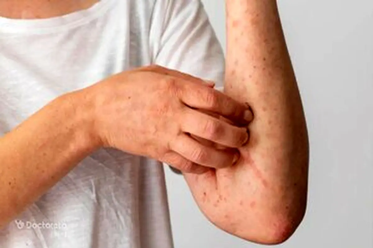 در مواجهه با اشعه فرابنفش چه کنیم؟

