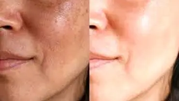  ترانگزامیک اسید چیست؟