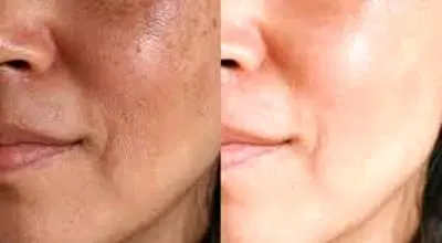  ترانگزامیک اسید چیست؟