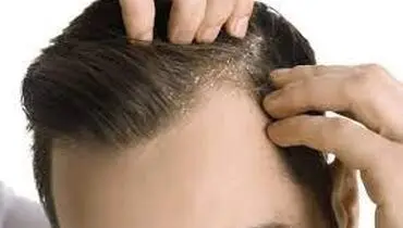 مواد غذایی مفید برای رهایی از شوره سر