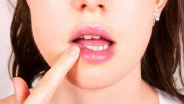 ۷ دلیل ابتلای مداوم به آفت دهان/اینفوگرافیک 