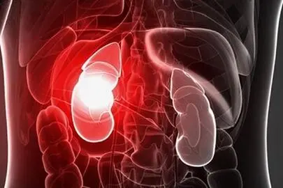 تصاویر دلخراش از یک سنگ کلیه زیر میکروسکوپ!
