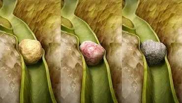 سنگ کیسه صفرا چطور ایجاد می‌شود؟