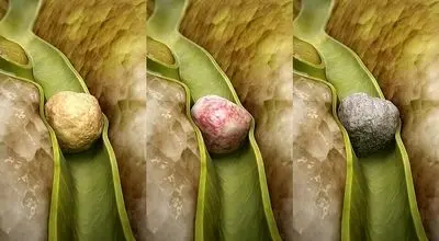 سنگ کیسه صفرا چطور ایجاد می‌شود؟