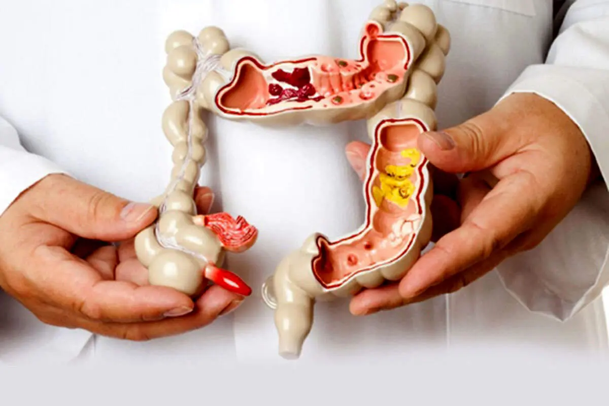پیشگیری از سرطان روده بزرگ با چند راهکار ساده و ارزان