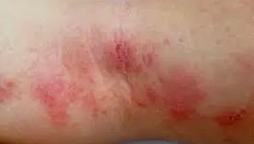 چه چیزی باعث اگزما و گال می شود؟
