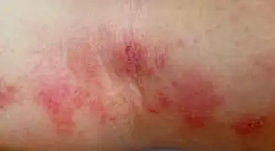 چه چیزی باعث اگزما و گال می شود؟
