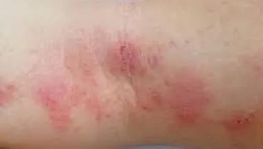 چه چیزی باعث اگزما و گال می شود؟
