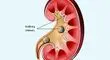  چرا مشکل سنگ کلیه در زمستان بیشتر می‌شود؟