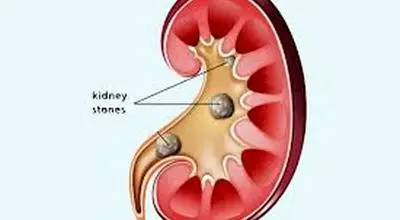 چرا مشکل سنگ کلیه در زمستان بیشتر می‌شود؟