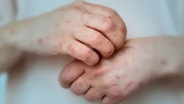 آبله میمونی همچنان در وضعیت اضطرار

