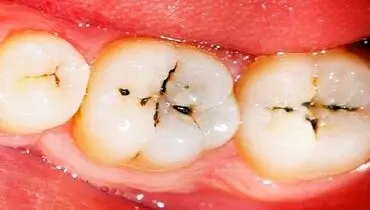پوسیدگی دندان شیری در کودکان را جدی بگیرید!/ شایع ترین مشکلات دندانی در کودکان
