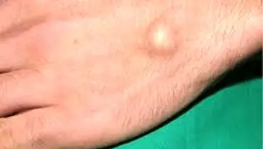 علل ایجاد توده سفت زیر پوست
