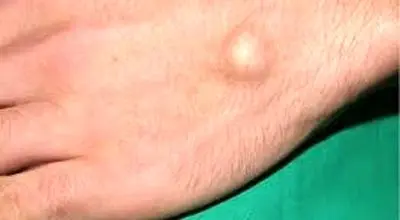 علل ایجاد توده سفت زیر پوست
