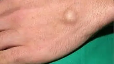 علل ایجاد توده سفت زیر پوست
