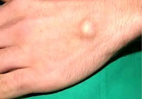 علل ایجاد توده سفت زیر پوست
