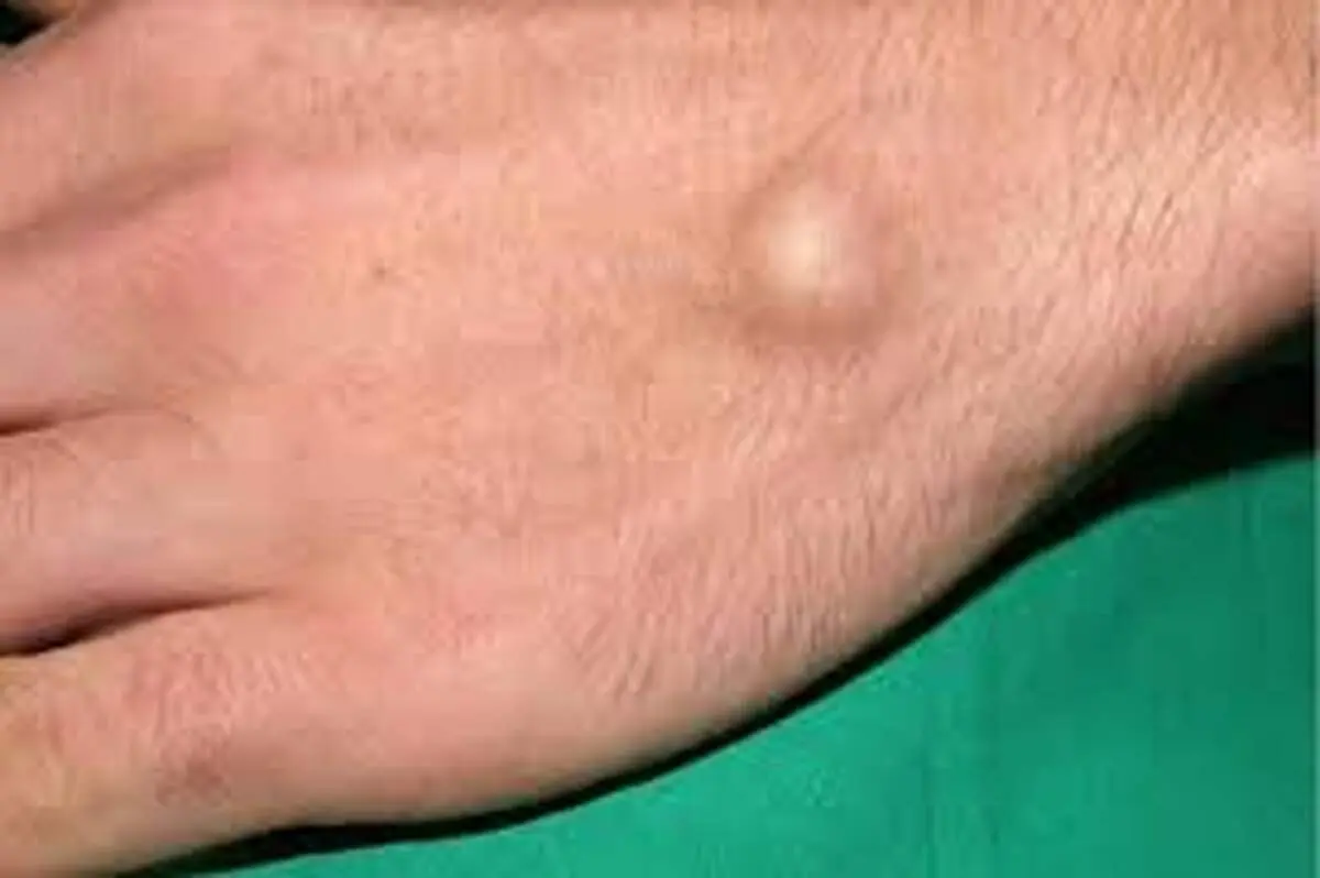 علل ایجاد توده سفت زیر پوست
